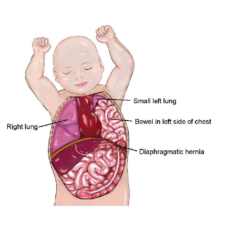 diaphragmatic hernia