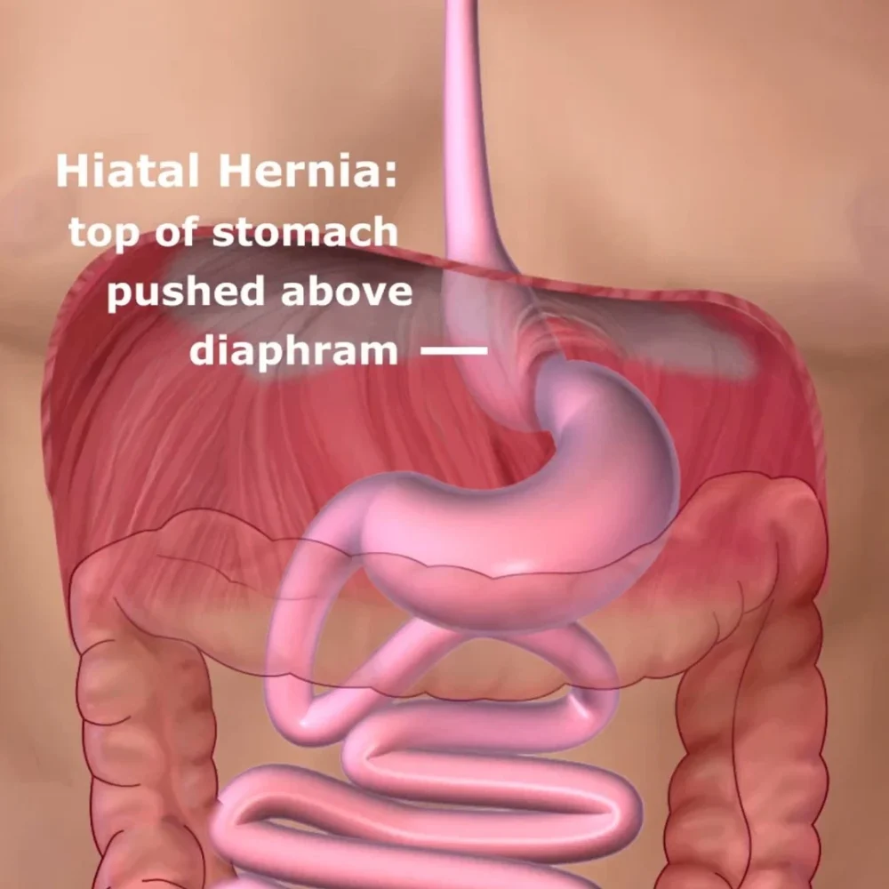 hiatal hernia