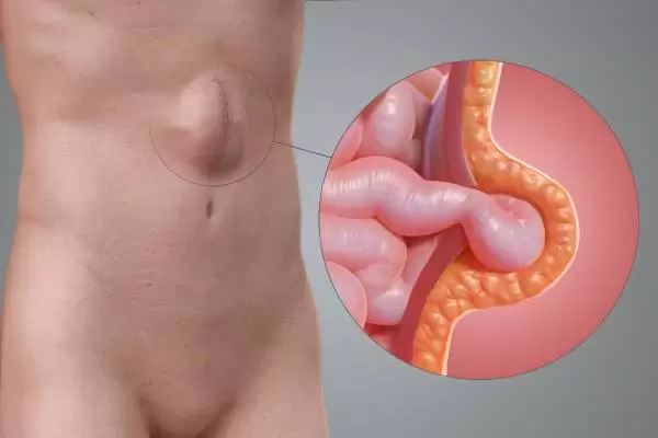 incisional hernia