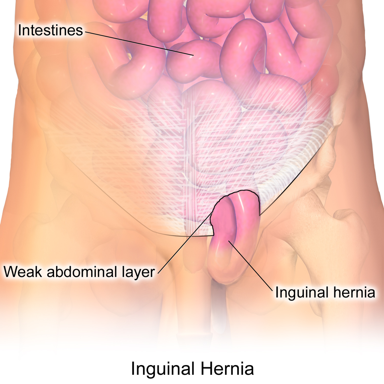 inguinal hernia